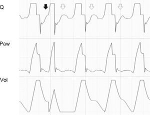 Tracing corresponding to a patient with conventional mechanical ventilation. The solid arrow shows inspiratory effort starting before Q reaches 0 (auto-PEEP). The second shorter Ti is observed because the pressure alert interrupts the cycle and opens the expiratory valve. In the following cycles, effort also starts in the presence of auto-PEEP, but fails to trigger the ventilator (ineffective inspiratory effort).