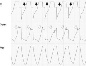 Tracing corresponding to a patient with conventional mechanical ventilation. The patient, with important ventilatory demand, increases the frequency (producing auto-PEEP, solid arrows). The Paw tracing shows insufficient inspiratory flow to cover the patient needs (hollow arrows).