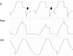 Tracing corresponding to a patient with conventional mechanical ventilation. Note that the expiratory flow shows a biexponential drop (black arrows). This phenomenon is related to dynamic collapse of the airway and, in some cases, can be normalized with the use of extrinsic PEEP (which behaves as an airway stent). Note also the presence of auto-PEEP (hollow arrows).
