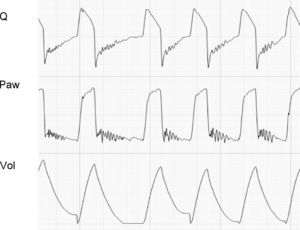 Tracing corresponding to a patient with pressure support ventilation. The Q tracing shows oscillations characteristic of the presence of secretions in the airway. In some cases such as this case, the phenomenon can also be seen in the Paw tracing.