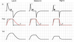 Effect of the increase in elastance during pressure-controlled ventilation. The peak inspiratory flow (hollow arrows) and the time needed for Palv to reach Paw (with the cessation of inspiratory flow, solid black arrows) decrease as E increases. In contrast to the situation observed in volume-controlled ventilation, the peak expiratory flow is not modified, because the pressure gradient between Palv and Paw does not change; expiration, however, ends previously due to the progressive reduction in tidal ventilation (solid gray arrows).