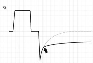 Schematic representation of the flow tracing in a patient with dynamic collapse of the airway. Exhalation begins normally, though beyond a certain point (arrow), a sudden change in resistance is observed, and the expiratory flow decreases and deviates from the expected tracing (dotted line).