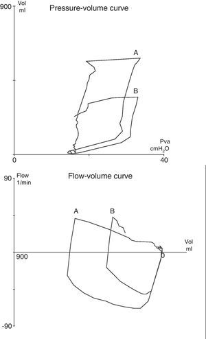 Pressure–volume (at top) and flow–volume (at bottom) tracings obtained in patient 6: (A) at baseline, and (B) during tension pneumothorax. As the patient was ventilated in pressure-controlled mode, the appearance of pneumothorax manifested as an acute drop in tidal volume, without changes in the airway pressures.