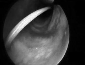 Endoscopic view during percutaneous tracheotomy, at the point of metal guide insertion.