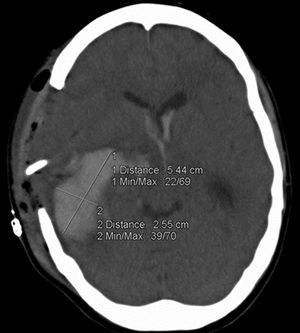 Scan showing a parenchymal hematoma after evacuation surgery and its method of volume measurement using ABC/2.