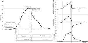 EAdi signal and characteristic respiratory curves during ventilation in NAVA. (A) EAdi signal. The start of inspiration is given by the increase in EAdi activity (first broken line) from the expiratory activity, which under normal conditions is 0. At the point where EAdi reaches a threshold value (first dotted line), the ventilator starts assist until EAdi drops to 70% of the maximum value (second dotted line). The neural inspiratory time comprises the period between the two solid lines, and ends when EAdi reaches its maximum value. The mechanical ventilatory time comprises the period between the two broken lines (inspiratory and expiratory cycling). Note that although minimal, there is a phase lag in the time between the neural and mechanical times due to the imposed cycling criteria. (B) The curves corresponding to pressure, flow and EAdi of a cycle show the perfect inspiratory (first broken line) and expiratory cycling synchrony produced immediately after the start of the neural time of the patient, in relation to the cessation of inspiratory effort. In the same way as in PAV, pressurization is gradual, and in NAVA follows or parallels the morphology of the inspiratory phase of EAdi. The NAVA level is 1, and we can see that the end-inspiratory pressure reached is 22cmH2O, which corresponds to EAdi (=12)×NAVA level (=1)+PEEP level (=10).