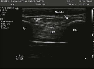 Ultrasound of the chest wall showing the structures visualized in the anterior chest. PMM: pectoralis major muscle; ICM: intercostal muscles; R4: fourth rib; R5: fifth rib; * denotes hydrodissection of the interfascial plane with the anesthetic solution inside this space. The arrow points the position of the needle crossing from the subcutaneous tissue up to the interfascial plane.