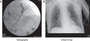 (A) Occlusive retrograde venography. (B) Chest X-ray view showing the electrode in the left ventricle.
