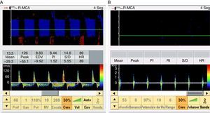 Middle cerebral artery explored through the temporal window with an inverted diastolic flow pattern (A) and systolic spikes (B), exhibiting a systolic peak of under 50cm/s, characteristic of cerebral circulatory arrest.