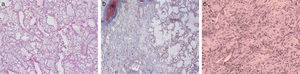 Diffuse alveolar damage (DAD). Case 1: A 42-year-old patient admitted to the intensive care unit (ICU) with septic shock associated to acute nosocomial pneumonia. Death occurred due to refractory hypoxemia after two days on mechanical ventilation. The postmortem study (Fig. a, hematoxylin–eosin [HE], ×5) showed a heterogeneous histological pattern with areas of DAD in the exudative phase, with the presence of hyaline membranes and interstitial and alveolar edema, vascular congestion of the interalveolar septae, and desquamation and hyperplasia of the type II pneumocytes. In other areas (Fig. b, HE, ×5) DAD in the organizing phase with lax interstitial and intraalveolar fibrosis was noted, together with hyaline membranes and the rest of the previously mentioned findings. Case 2: A 28-year-old patient admitted to the ICU due to ARDS secondary to respiratory sepsis attributed to H1N1 influenza. Death occurred due to refractory hypoxemia after 48 days on mechanical ventilation. The lung tissue micrograph (Fig. c, HE, ×5) obtained at autopsy showed evolved DAD in the fibrotic stage, with great distortion of the lung parenchyma and practically complete substitution of the alveolar spaces with fibrotic tissue.