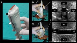 (A) Lineal transducer. The transducer indicator is in this case represented by a salient (black arrow) and a dark-gray line (white arrow). This indicator demarcates the beam leading edge that corresponds to a mark on the screen (in this machine, “HD” in B and C). (B) In the short axis, the probe indicator is pointing toward the operator