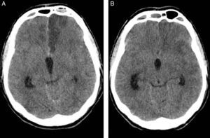 (A) TAC sin contraste a las 24 horas postembolización del aneurisma. Hipodensidad cortico-subcortical en territorio de ACA izquierda consecuencia de la complicación embolígena. (B) TAC sin contraste preangioplastia para tratamiento del vasoespasmo cerebral en el día 12° de HSA. Desaparición de la hipodensidad en territorio tributario de ACA izquierda (fogging effect).