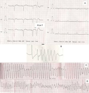 (A) R on T phenome; (B) R on T phenome, followed by ventricular ectopies; (C) ventricular tachycardia; (D) ventricular tachycardia degenerating into ventricular fibrillation.