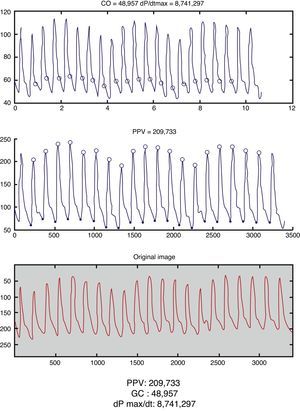Screenshot from the app Capstesia (GalenicApp®, Vitoria-Gasteiz, Spain) showing the haemodynamic calculations made from the photocopy of one invasive arterial blood pressure seen in the lower side of the image.
