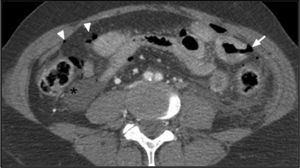 Abdominal CT scan showing peritoneal fluid (asterisk), pneumoperitoneum (arrow heads) and focal perforation (arrow) of a bowel loop with a thickened wall.