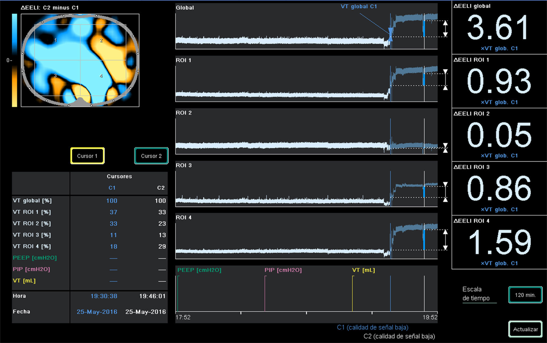 Peep Test Timer What PEEP level should I use in my patient? | Medicina Intensiva