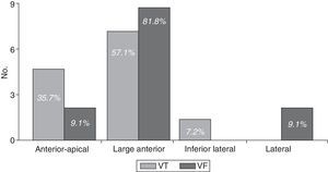 Distribution of patients based on the location of the AMI, and the incidence of ventricular arrhythmias. VF: ventricular fibrillation; VT: ventricular tachycardia.