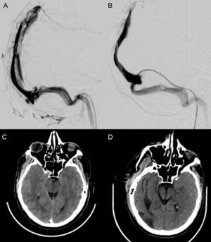 (A) Phlebography showing a filling defect in the superior longitudinal sinus. (B) Phlebography with the absence of filling defects and adequate drainage through the left transverse sinus. (C) Brain CT scan showing evidence of intracranial hypertension (bilateral erasure of the convexity sulci, diminished basal cistern size, increased mesencephalic anteroposterior axis). (D) Brain CT scan at discharge, showing improvement of the indirect signs of intracranial hypertension.