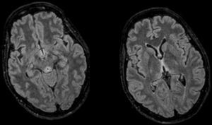 Axial FLAIR MRI sequence: hyperintense lesions at periaqueductal level and around the third ventricle confirmed–all of them typical of Wernicke