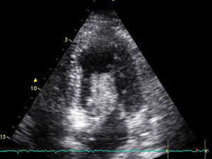 Apical projection view of the four chambers, showing the atrial myxoma penetrating into the left ventricle through the mitral valve.