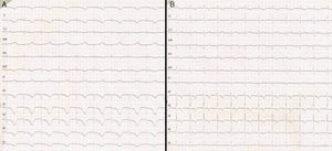 (A) Twelve-lead electrocardiographic tracing corresponding to day two after onset of the condition, with a QTc interval of 680ms. (B) Electrocardiogram corresponding to evolutive day 10, showing a QTc interval of 475ms, but with persistent T-wave inversion.