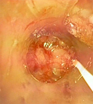 View of tracheal lumen through fibrobronchoscopy.