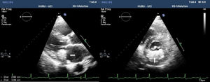 Transthoracic echocardiography: the image at left (longitudinal plane of the long axis of the left ventricle) shows a hyperechogenic, large mass associated to the posterior leaflet of the mitral valve (arrows). The lesion presents well defined margins, with an internal echolucency corresponding to CDMV. The image at right (longitudinal plane of the short axis of the left ventricle) shows the described lesion to be limited to the posterior leaflet of the valve (arrow).