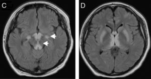 Progression of the lesions to cerebral peduncles and basal ganglia.