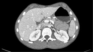 CT scan. The arrows show the location of the rupture.