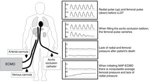 Scheme suggested to confirm the correct position of the balloon for aortic occlusion purposes.