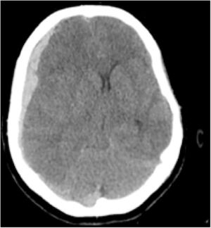 Cranial CT scan (axial slice). Right hemispheric extra-axial hyperdense collection consistent with an extensive acute subdural hematoma with significant mass effect.