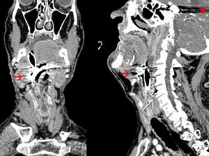 CAT scan cranial, coronal and sagittal slices with metallic artifacts.