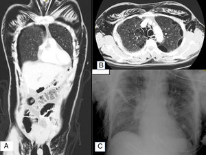 (A) Computed tomography scan showing important post-trauma subcutaneous emphysema. (B) Axial computed tomography view showing bilateral pulmonary bullae and subcutaneous emphysema. (C) Chest radiograph after placement of two right pleural drains.