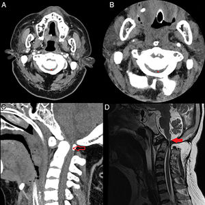 (A) Computed tomography scan in 2008: axial acquisition at C1–C2 level showing spinal cord canal stenosis (6mm) (grey asterisk). (B) Computed tomography scan in 2018: axial acquisition at C1 level showing spinal cord canal stenosis (6mm) (grey asterisk). (C) Computed tomography scan: sagittal acquisition showing the already known canal stenosis at the craniocervical junction, with no apparent soft tissue lesions (vacant grey arrow). (D) Magnetic resonance imaging: T1-weighted acquisition showing canal stenosis with diffuse dural thickening and signal alteration in lower bulbar zone, together with cervical intramedullary image consistent with traumatic myelopathy (solid grey arrow).