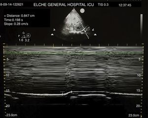 Lung ultrasound of right hemithorax (mode M). It reveals the presence of one 0.8mm-diaphragmatic excursion suggestive of right diaphragmatic paralysis.