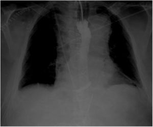 Handheld thoracic X-ray performed to verify the nasogastric tube showing mediastinal widening due to aortic dissection and radiological contrast in the proximal esophagus reminiscent of an esophagram.