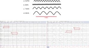 Normal brain waves. (a) Alpha (8–12Hz), (b) Beta (13–30Hz), (c) Zeta (4–7Hz), (d) Delta (0.1–3Hz).