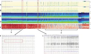 Four hour-qEEG on a 56-year-old patient with abnormal mental status, fever, and rigidity at the back his neck. The patient was diagnosed with streptococcal meningitis complicated with nonconvulsive status epilepticus. Multiple electrographic seizures were recorded that originated inside the right hemisphere of the brain (confirmed by the greater amplitude of the right hemisphere compared to the left one. Panels C and D) and (a) by the relative asymmetry spectrogram (panel E) with more of a red (right hemisphere) than a blue image (left hemisphere). Also, (b) the relative asymmetry spectrogram looks red prior to the seizure due to the great interictal activity seen on the right hemisphere of the brain. Panels A and B are detectors of rhythmicity, a measure where the EEG tracing looks darker in the presence of periodic or rhythmic activity and is seen as a dark band to the frequency of the periodic activity. This spectrogram shows rhythmicity between 1 and 25Hz and, in this example shown, we can see rhythmicity asymmetry predominantly on the right hemisphere, especially in slow frequencies (delta). (c) The EEG shows one slow amplitude seizure originated at the right posterior quadrant (P4, P8, O2) that progresses diffusely over the right hemisphere of the brain with monomorphic delta activity and overlapped peaks. This activity has a wide field of action on the right hemisphere of the brain.