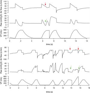 Flow dyssynchrony in volume-assist control ventilation with decelerating (a) and constant flow (b). Delivered flow is insufficient to meet the patient