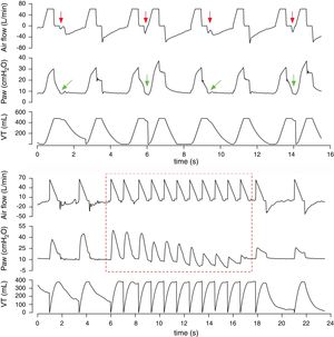 (a) Reverse-triggering in volume-assist control ventilation. In the first breath, mechanical insufflation is time-triggered; at the end of mechanical inspiration, reverse-triggering is seen as a negative deflection in airway pressure (Paw) (green arrows) and an increase in expiratory flow (red arrows). The third time-triggered breath is followed by a fourth, induced by reverse-triggering before complete exhalation, resulting in breath-stacking; this pattern repeats in following cycles. (b) Multiple cycling in volume-assist control ventilation with decelerating flow: the sudden cluster of mechanical insufflations without associated expiratory flow and automatic change from time-triggering to flow-triggering with progressive decrease in airway pressure (Paw) (dotted-line square) are due to massive air leakage caused by endotracheal tube displacement from the main airway; after spontaneous tube repositioning, Paw and expiratory flow recover, resulting in a change back from flow-triggering to time-triggering. This situation carries a high risk of unplanned extubation, which here occurred shortly afterward.