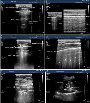 Patterns of airing of the pulmonary region. A) Typical pattern of normal airing (profile A in the BLUE protocol) showing 2D imaging. B) Pattern A on M-mode. C. Pattern B1. D) Pattern B2. E) Pulmonary consolidation (profile C in the BLUE protocol) showing shred sign. F) Air bronchogram. A, B, C, D, and E: linear probe study; F, convex probe.