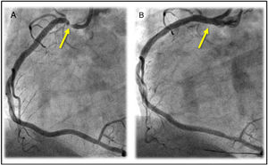 A) Critical ostial injury (arrow) of the right coronary artery with normal antegrade flow. B) Result of implanting a drug-eluting stent in the proximal right coronary artery (arrow) with minimal protrusion in the aortic root.