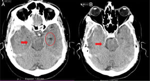 Uncal or transtentorial herniation. (A) Collapse of the temporal horn and cisterna ambiens ipsilateral to the expansive lesion (arrow). Dilatation of the contralateral temporal horn (circle). (B) Dilatation of the ipsilateral cerebellopontine cistern (arrow) (courtesy of Ángela Meilán, Department of Radiology, Hospital Universitario Central de Asturias).