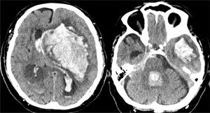 Brain CT scan revealing massive hemorrhage of the left basal ganglia, opening to the ventricles, midline displacement and important brain edema with signs of brain herniation.