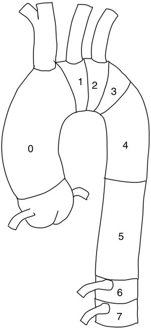Classification of the proximal anchoring zones of the endoprosthesis in the descending thoracic aorta.