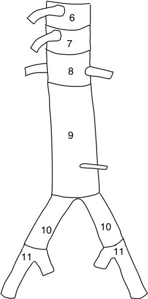 Classification of the distal anchoring zones of the endoprosthesis in the descending thoracic aorta.