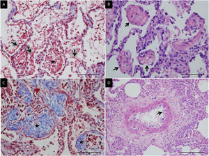 Microscopic lung findings in Covid-19. (A) Loose intra-alveolar fibrin exudates (arrow), admixed with inflammatory cells (star). Masson's trichrome. (B) Intra-alveolar “fibrin balls” (arrow). Hematoxylin-eosin staining. (C) Intra-alveolar loose fibrous plugs (star) of organizing pneumonia. Masson's trichrome. (D) Endotheliitis (arrow) in a small arterial vessel. Hematoxylin–eosin staining. The scale bar corresponds to 50μm for A, B and C, and 100μm for D.