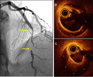 A) Patient with acute coronary syndrome (ACS) with a severe and long angiographical lesion (without double lumen) typical of a spontaneous coronary artery dissection (SCAD) in the left anterior descending coronary artery middle segment (arrows). B and C) The optical coherence tomography images reveal the presence of an intima-media membrane and a large intramural hematoma (yellow asterisks) compromising the true lumen. The white asterisk points at the shadow caused by the guidewire; the circular image in the true lumen corresponds to the intracoronary imaging catheter.