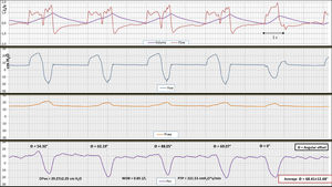 Registry of flow, volume, airway pressure (Paw), vesical pressure (Pves), and esophageal pressure (Pes) in assist-control ventilation mode and continuous flow in the first case. Note the first 4 DTV-type double cycling consecutive cycles. There is an intense patient’s respiratory driver in all the cycles, evident in the delta esophageal pressure (DPes), although at a lower rate than the one programmed in the ventilator. In cycle #5 the patient-triggered mechanical assist inspiration without DT or RT is evident. Figure shows 2 very well-defined respiratory drivers, (one the machine’s and the other the patient’s). Both of a similar intensity (patient’s WOB in 0.85J/L and PTP of 222.53cm H2Os/L). The patient’s inspiratory effort is similar in all the cycles (assisted in cycle #5, and the first 4, DTVs), which is suggestive of a patient’s vigorous respiratory driver (approximate DPes at 30cmH2O) less common and regular compared to the machine one but, in any case, an inexistent driver or a driver “dragged” by the ventilator. The measurement of angular mismatch (θ=68.41°±12.48°) between the patient’s cycle and the ventilator cycle is very different, which also goes against a reflex mechanism. No mismatch in the last assisted cycle reported. In this case the DT-RT 1:1 ratio appeared in 60% of the registry. In the remaining registry it was variable with a 1:2 and 1:3 ratio. In this case, the increased TV of DTV went from 500 cc to almost double. At the same time, the I/E ratio went down to 1:1, a probably unwanted effect. This registry depicts the need for close monitoring when administering presumably protective mechanical ventilation.