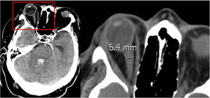 Measurement of optic nerve sheath on the cranial CT scan.